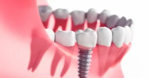What is Implant Treatment?