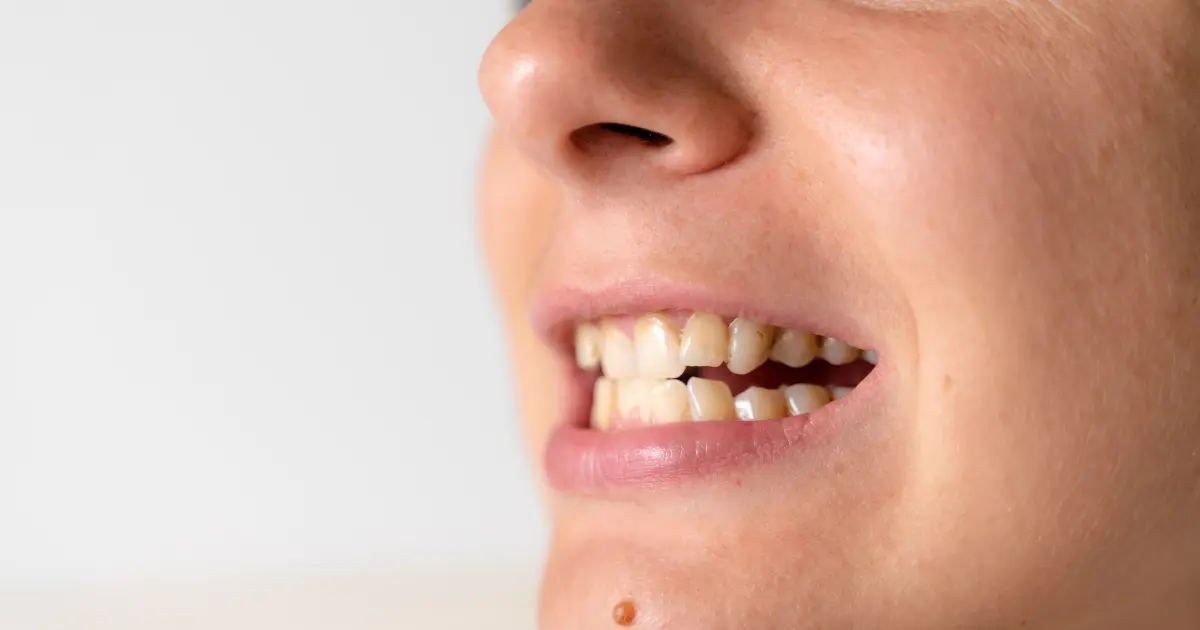 سوء الإطباق