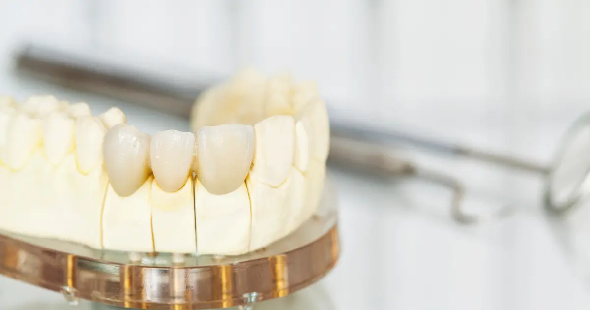 تاج الأسنان