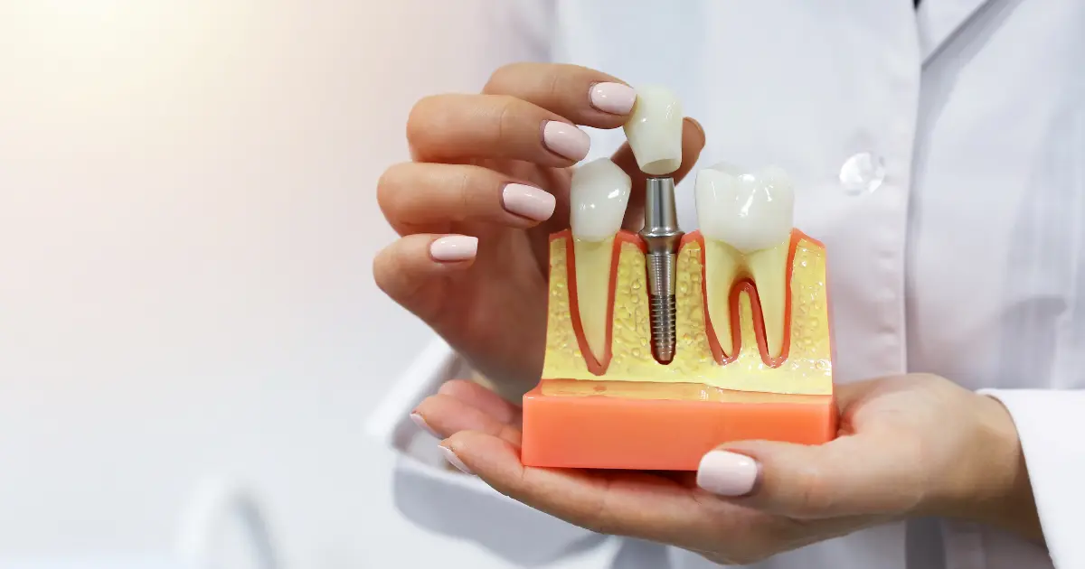types of dental implants
