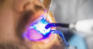 types of dental fillings