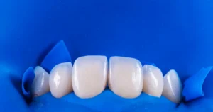 dental veneer