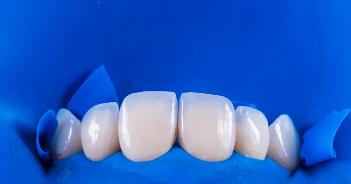 dental veneer