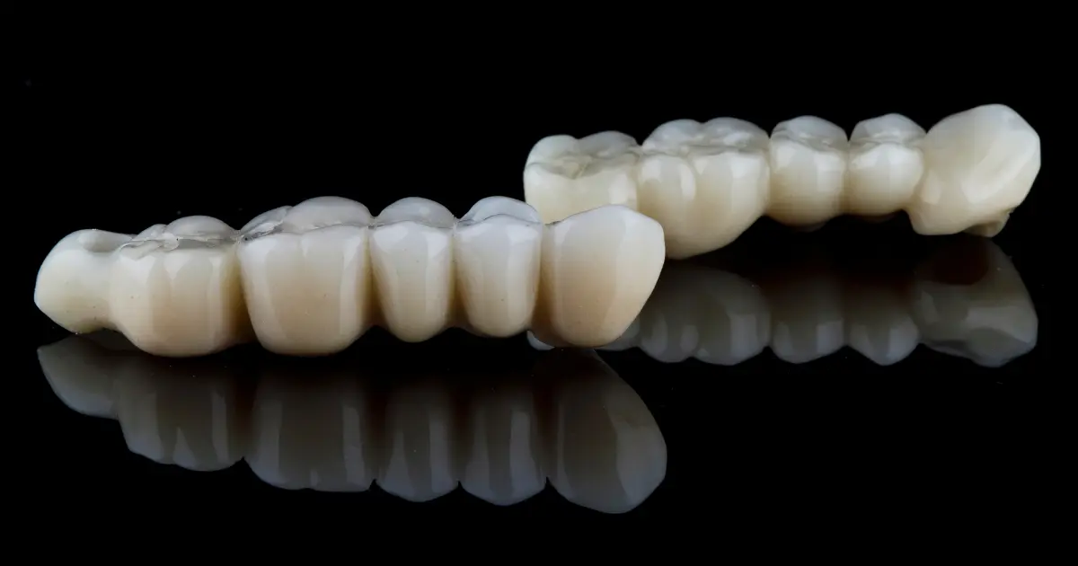 dental bridge vs implant