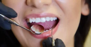 diş kaplama ve implant