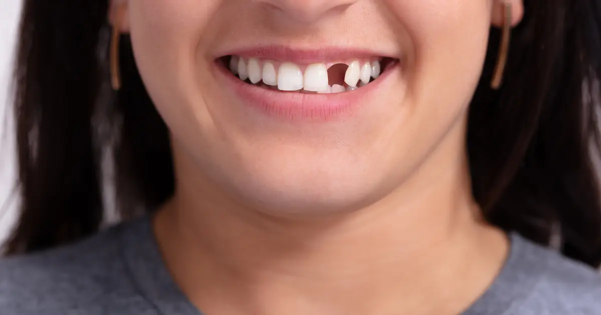 الفجوات بين الأسنان