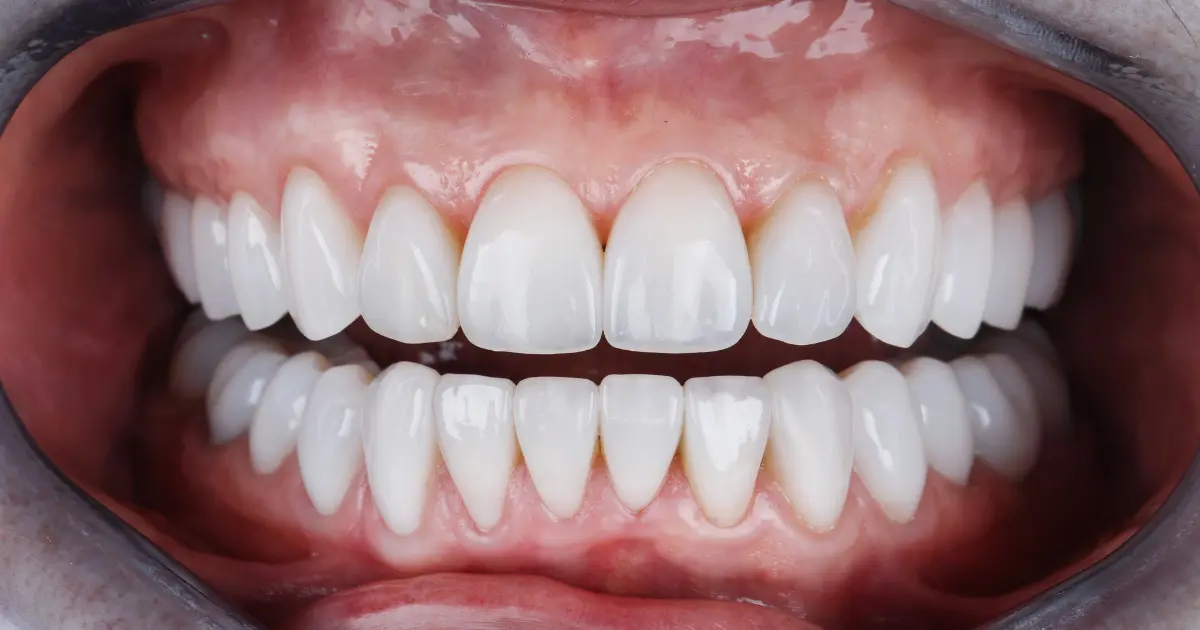 types of veneers