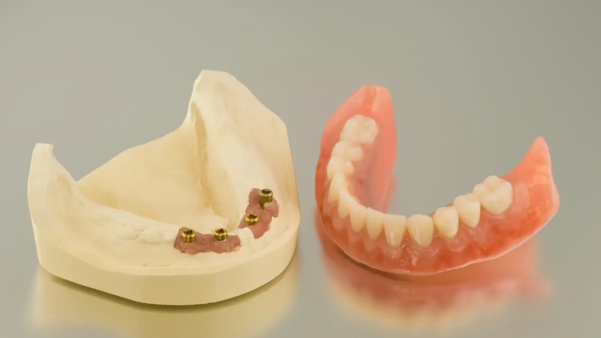 Benefits Of İmplant-Supported Dentures Compared To Traditional Dentures
