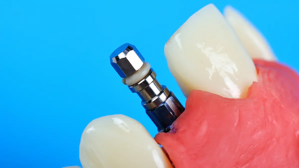 Benefits Of Titanium Implants