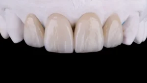 Composite Veneer in Cosmetic Dentistry