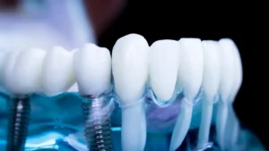 Factors to Consider When Choosing Full Mouth Dental Implants