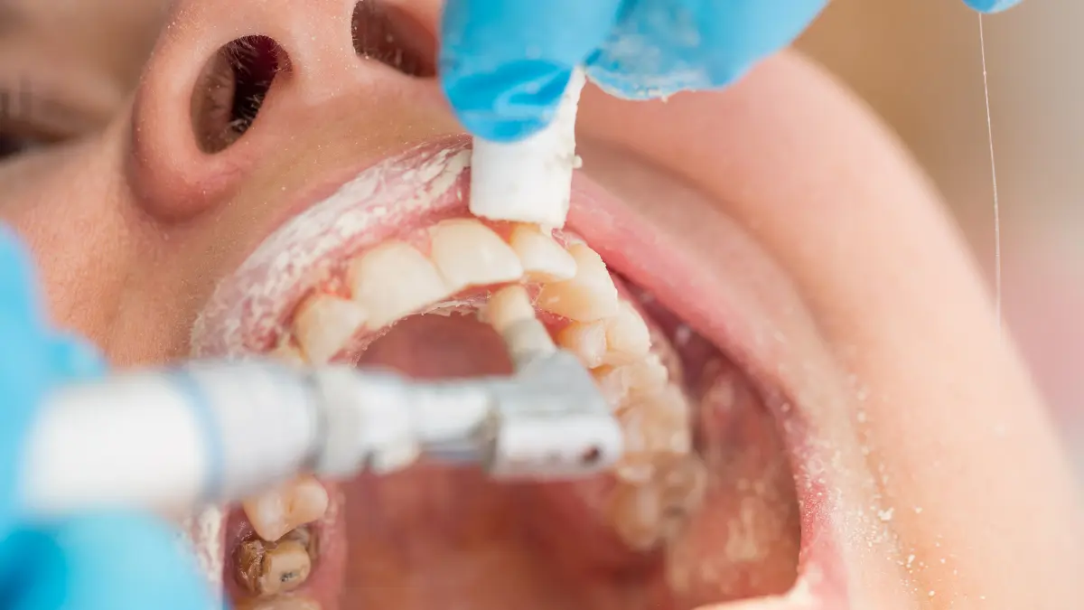 The İmportance Of A Dental Deep Cleaning For Total Oral Health