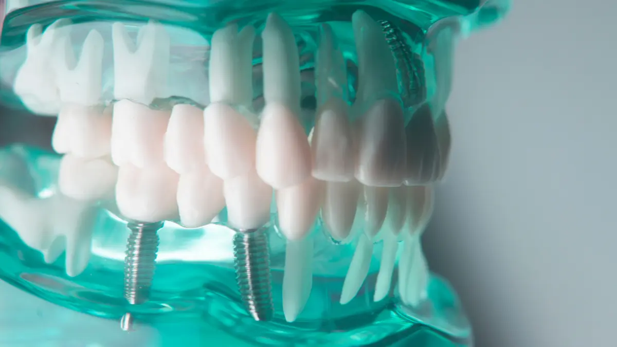 Titanium Implants: Benefits, Types, Maintenance