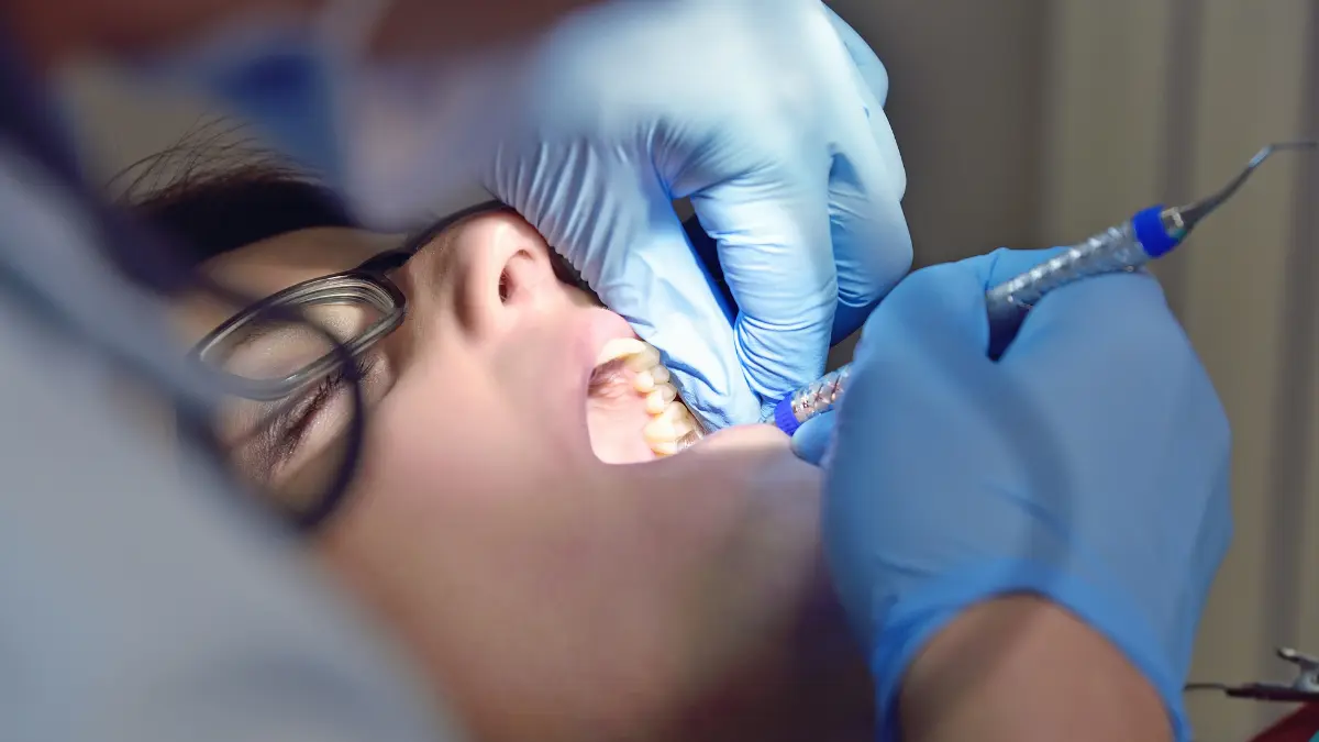 are the black line stains on teeth permanent