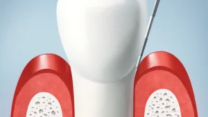 Diş eti şekillendirme nedir, nasıl yapılır?