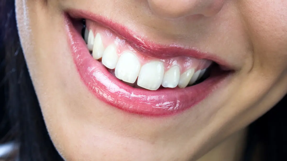 Gülüş tasarımı nedir nasıl yapılır?