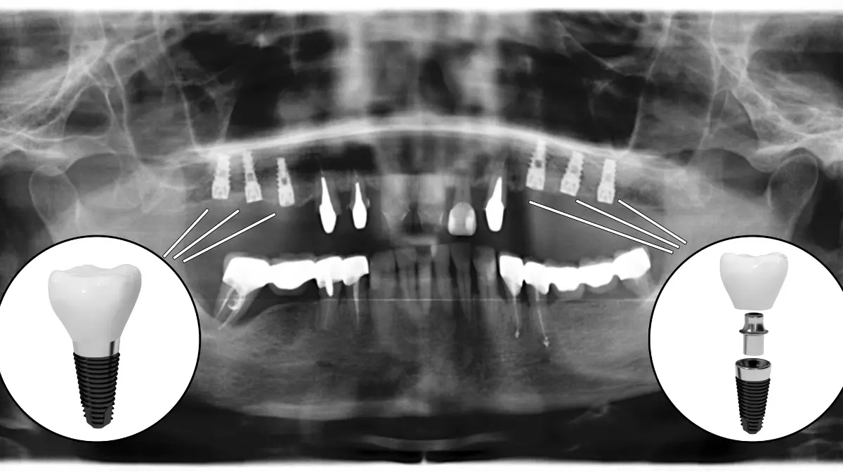 how is dental cbct done