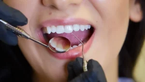 how to prepare teeth for veneer