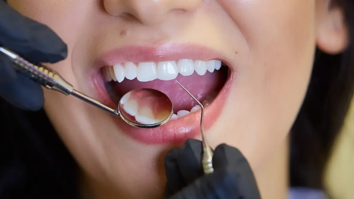 how to prepare teeth for veneer