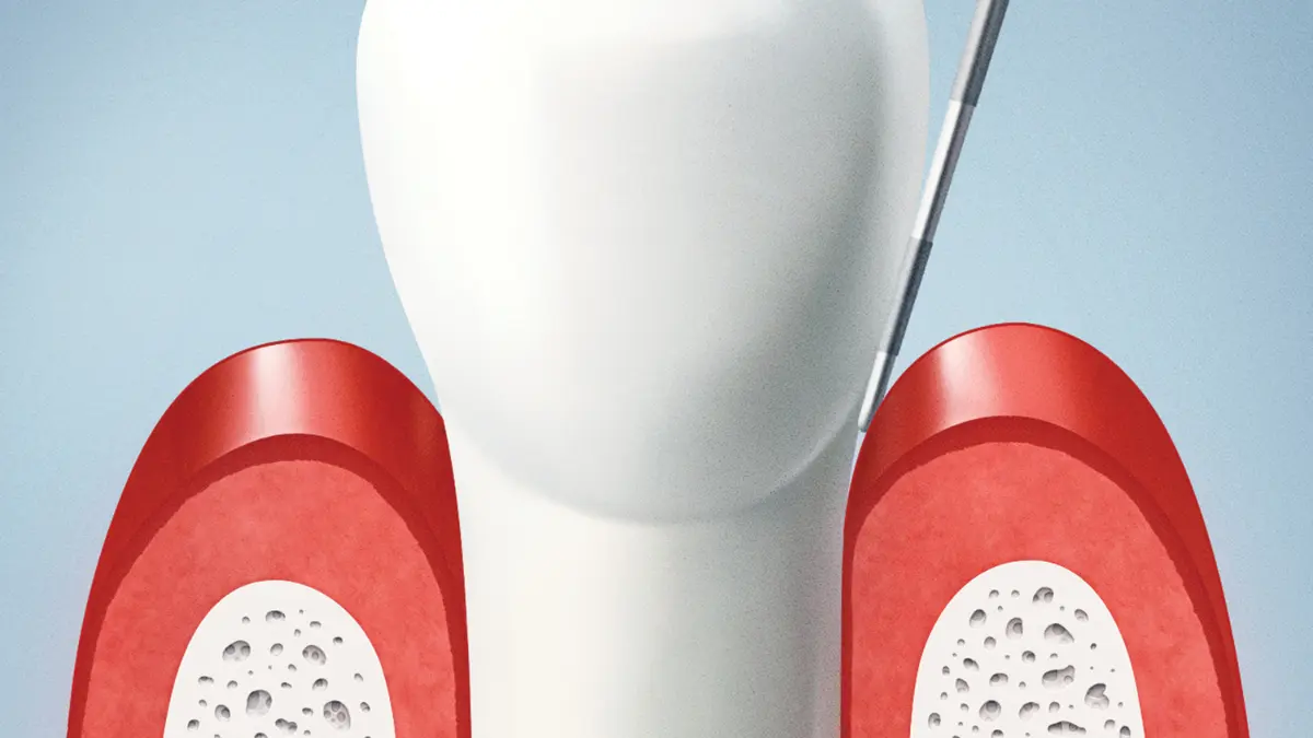 تشكيل اللثة