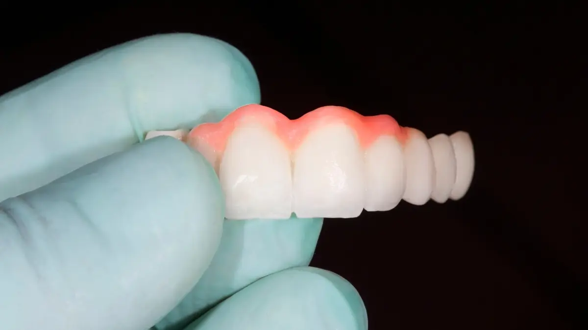 Qu’est-ce que Dental Bridge ?