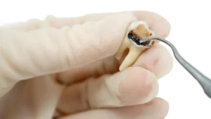 qu’est-ce que la restauration dentaire