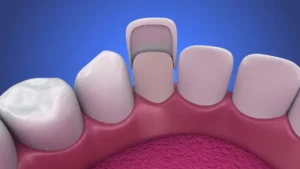 savoir combien de temps durent les dents stratifiées