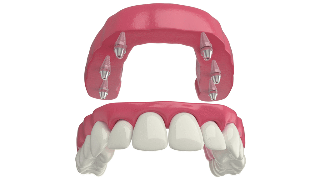 Aynı Gün Takma Dişler