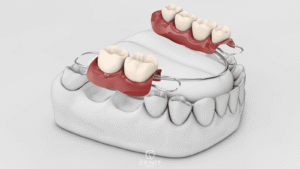 Aynı Gün Takma Dişler