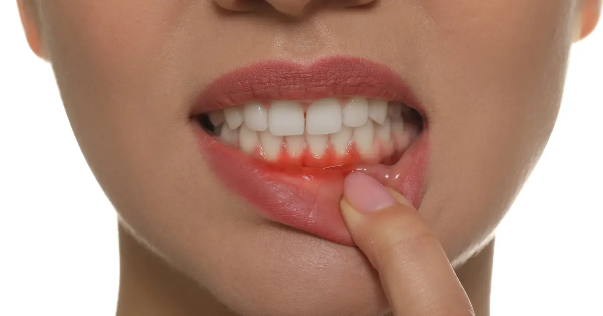 How to Spot Early Signs of Gum Recession