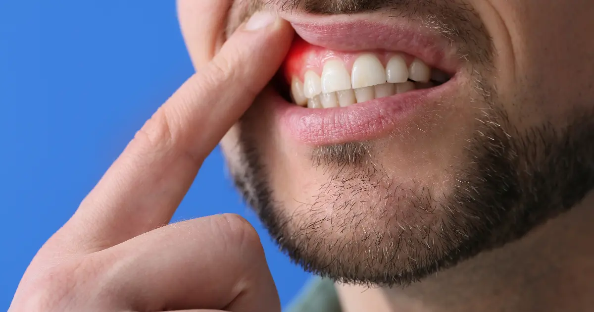 استئصال اللثة