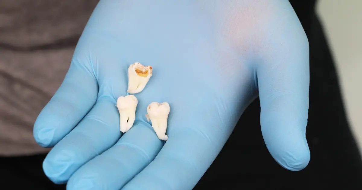How to Prevent Operculum Dental