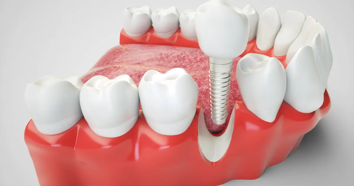 İmplant Diş Prosedürü