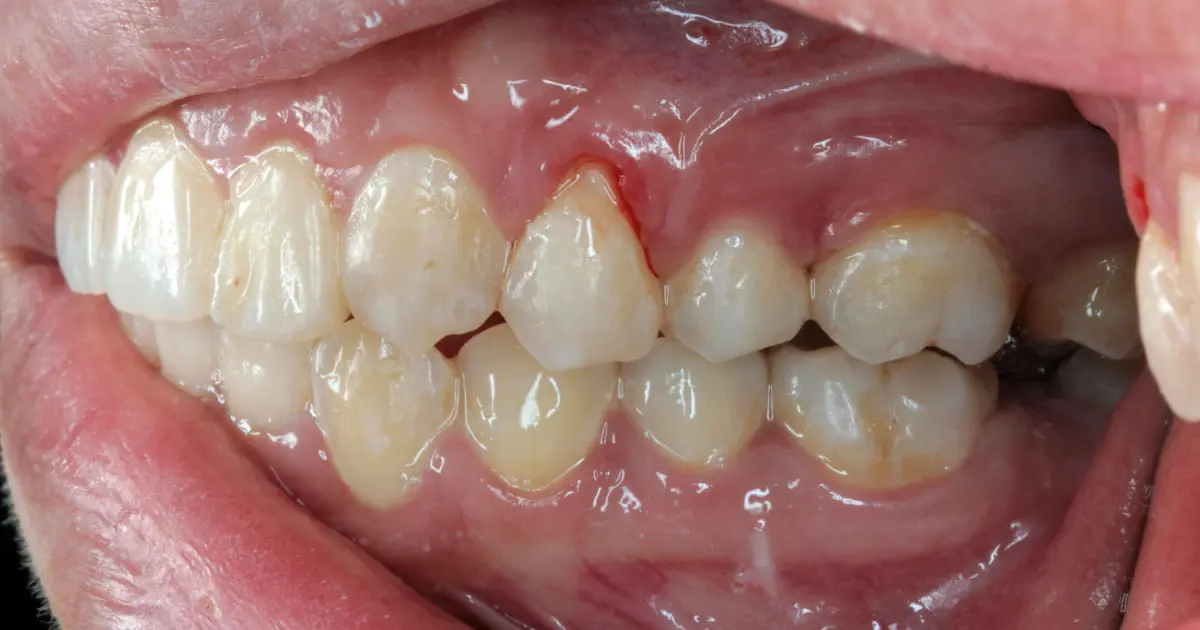 Needs to Know About Receding Gums