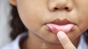 لماذا تظهر القرحة في الفم؟