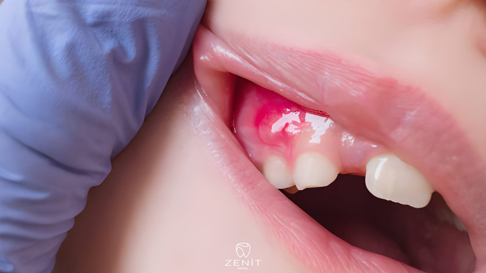 İltihaplı Diş Ağrısı Nasıl Geçer