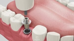 Why Should I Choose Implant Treatment in Turkey?