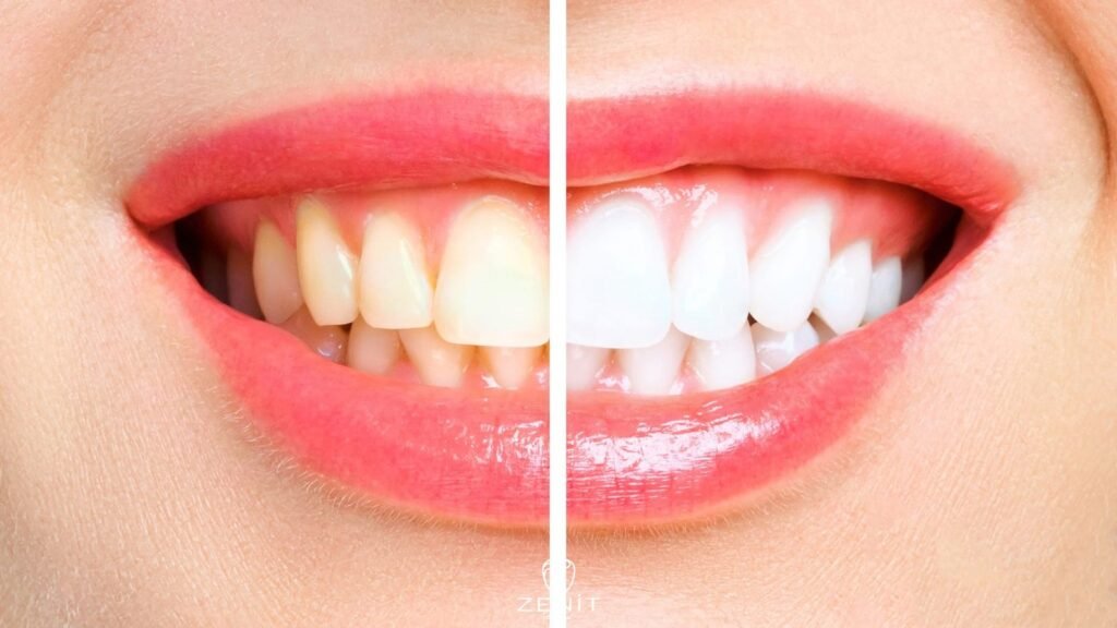 What is Teeth Whitening