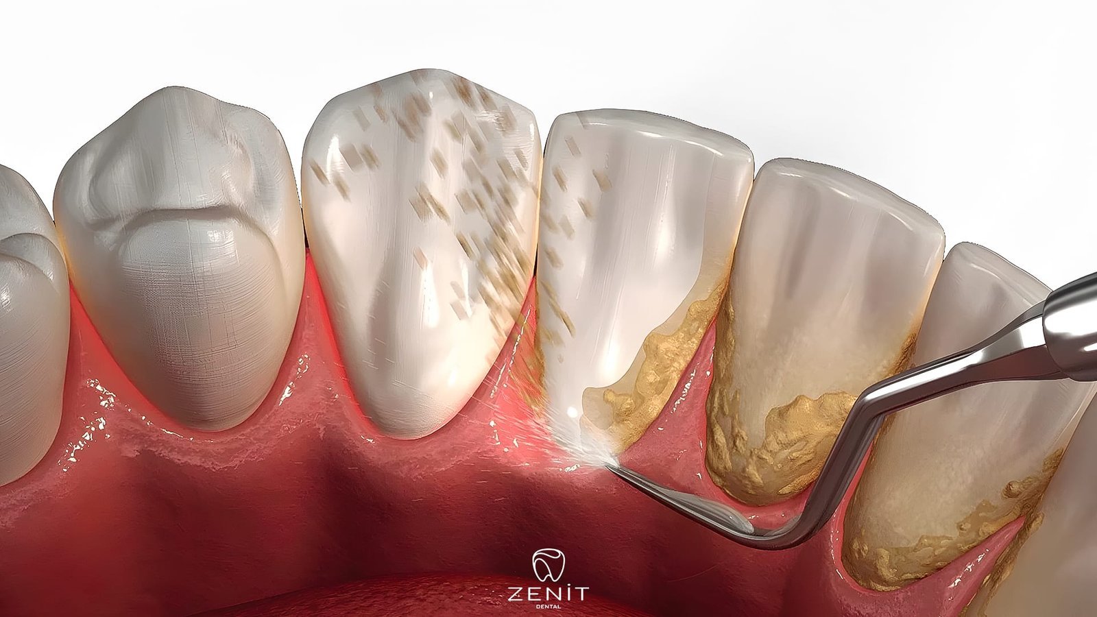 Zahnzwischenräume Reinigen