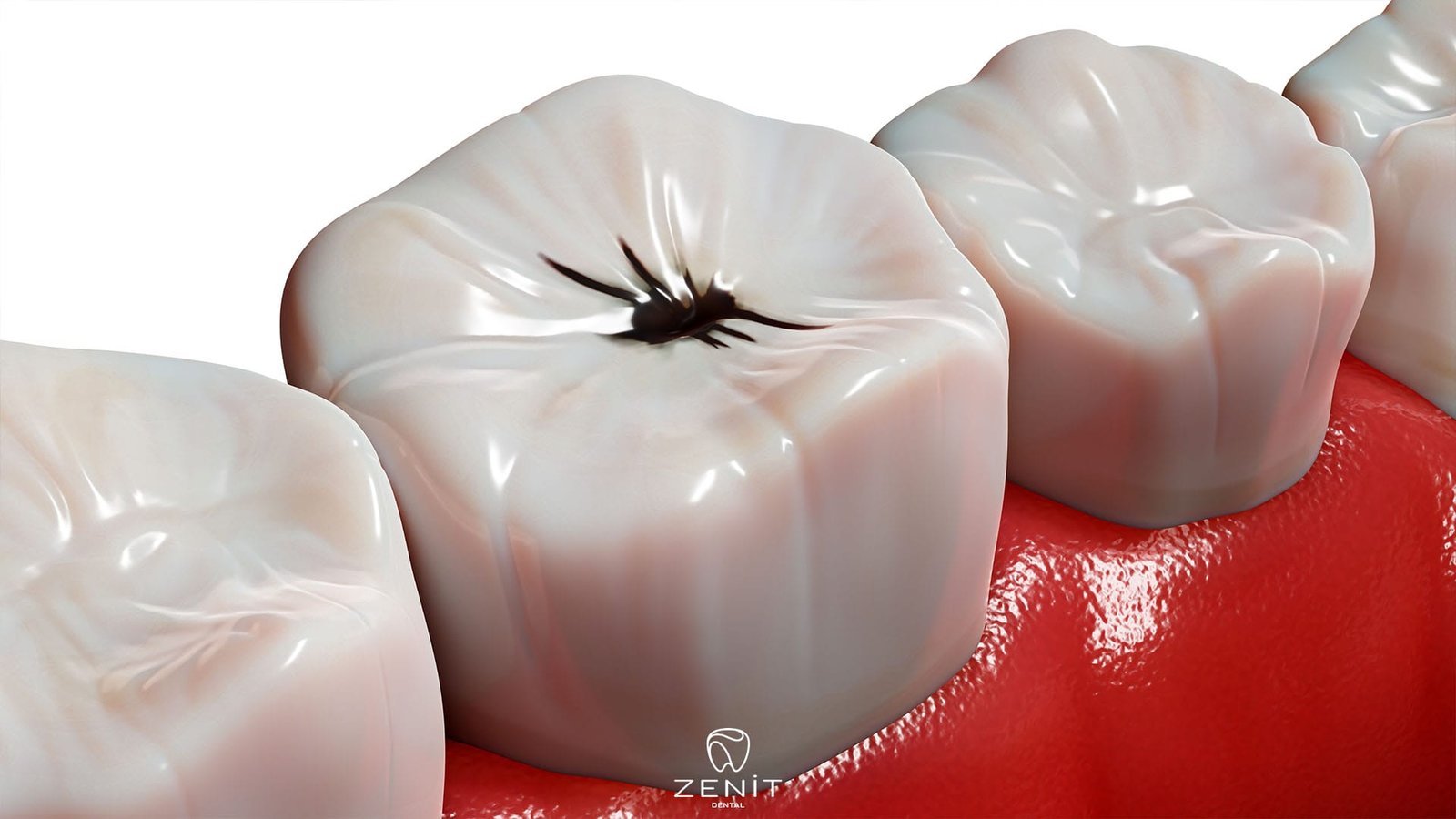 Diş Çürüklerinin Nedenleri 