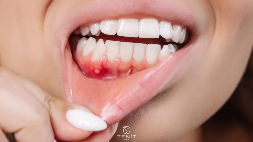 Inflammation in Gums