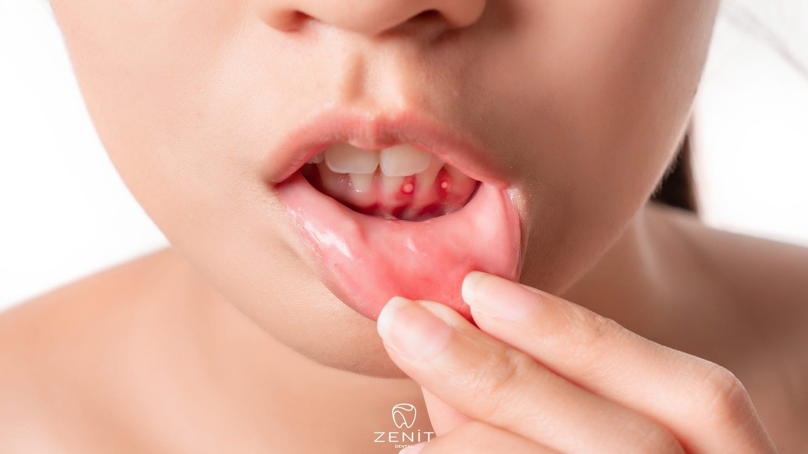 Diş Etinde İltihap