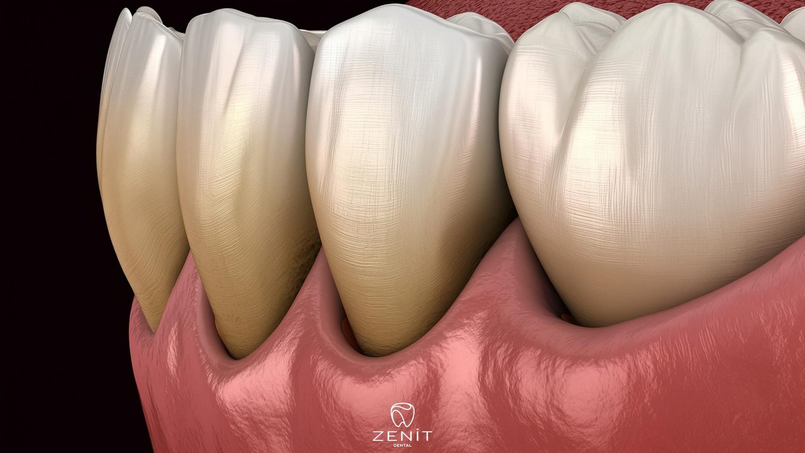periodontal cep