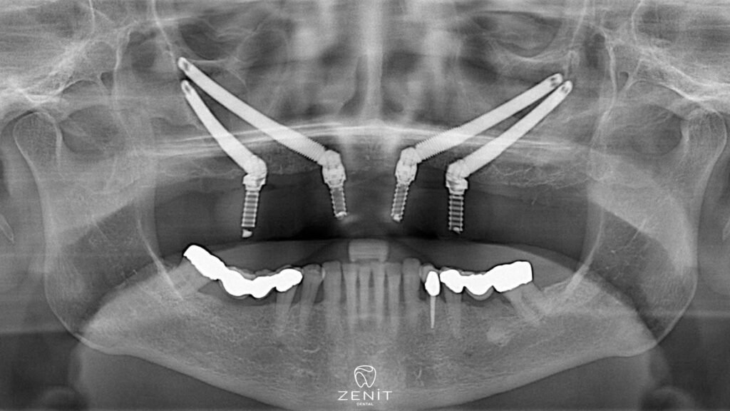 Zygoma Implant