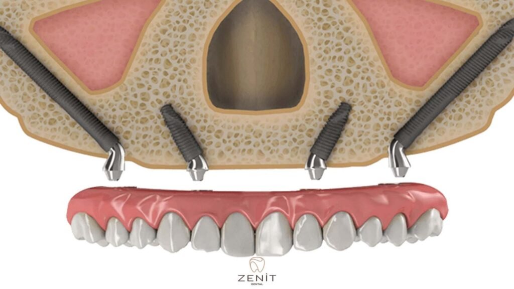 Zygoma Implant