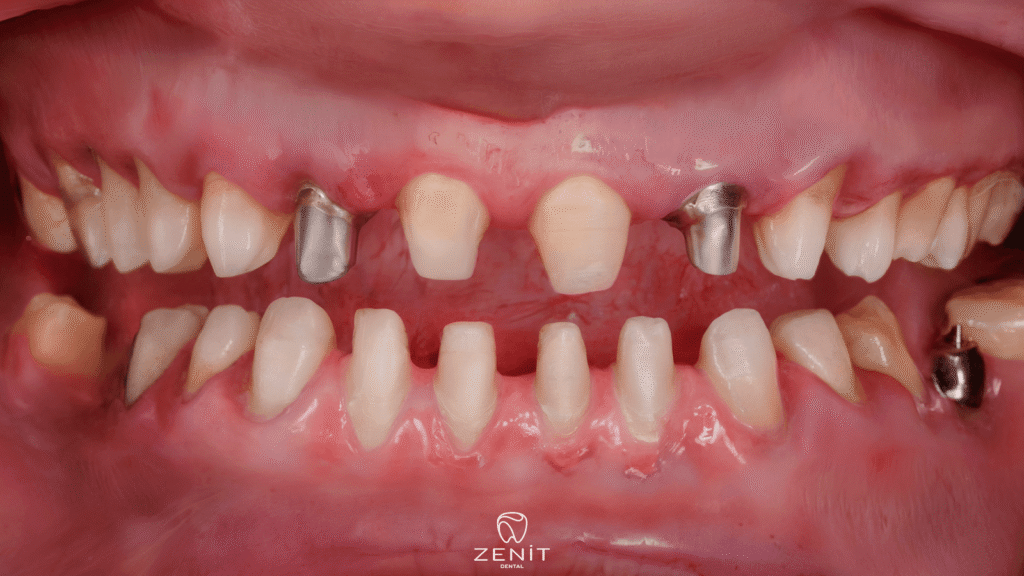 Severe Pain After Tooth Cutting