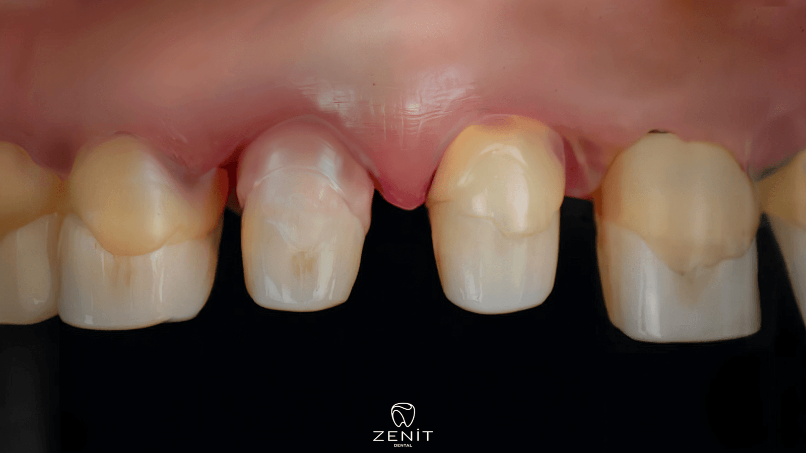 Diş Kesimi Sonrası Şiddetli Ağrı