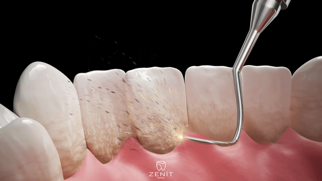 Is Dental Stone Cleaning Harmful