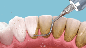 Diş Taşı Temizliği Zararlı Mı