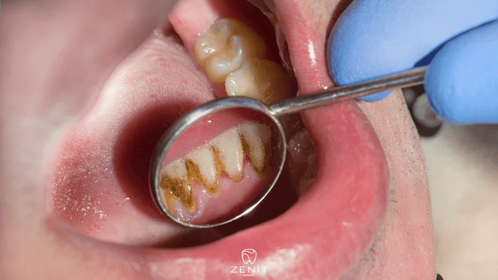 Is Dental Stone Cleaning Harmful